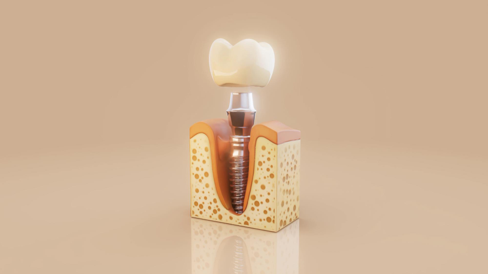 Dental implants treatment