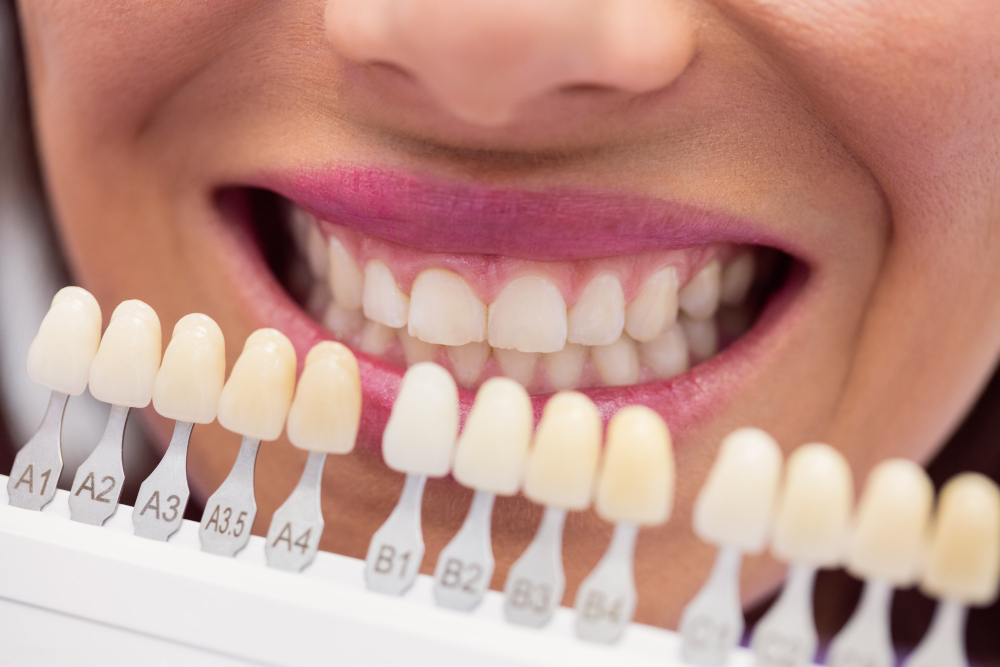 Teeth whitening treatment